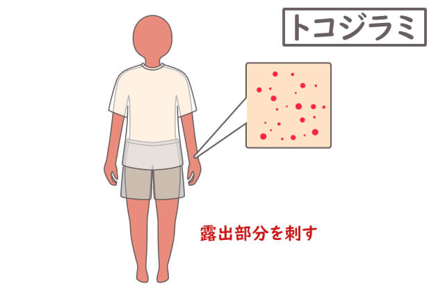 トコジラミ　刺される場所