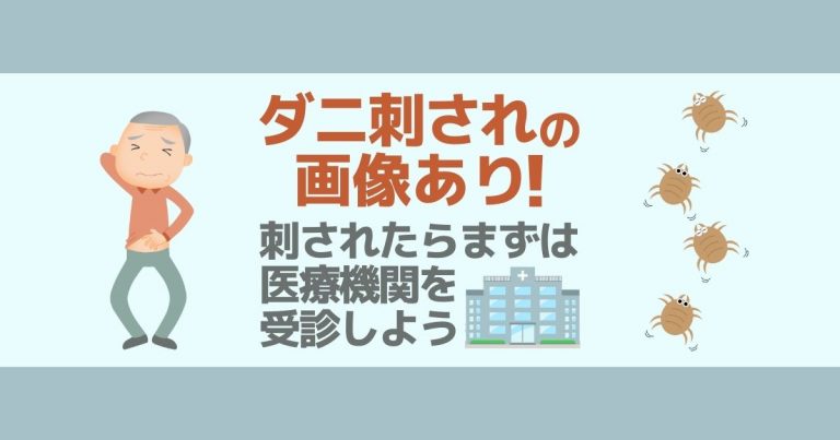 【写真あり】ダニに刺された跡の特徴と症状｜他のかゆい虫刺されとの違い | 害虫駆除110番