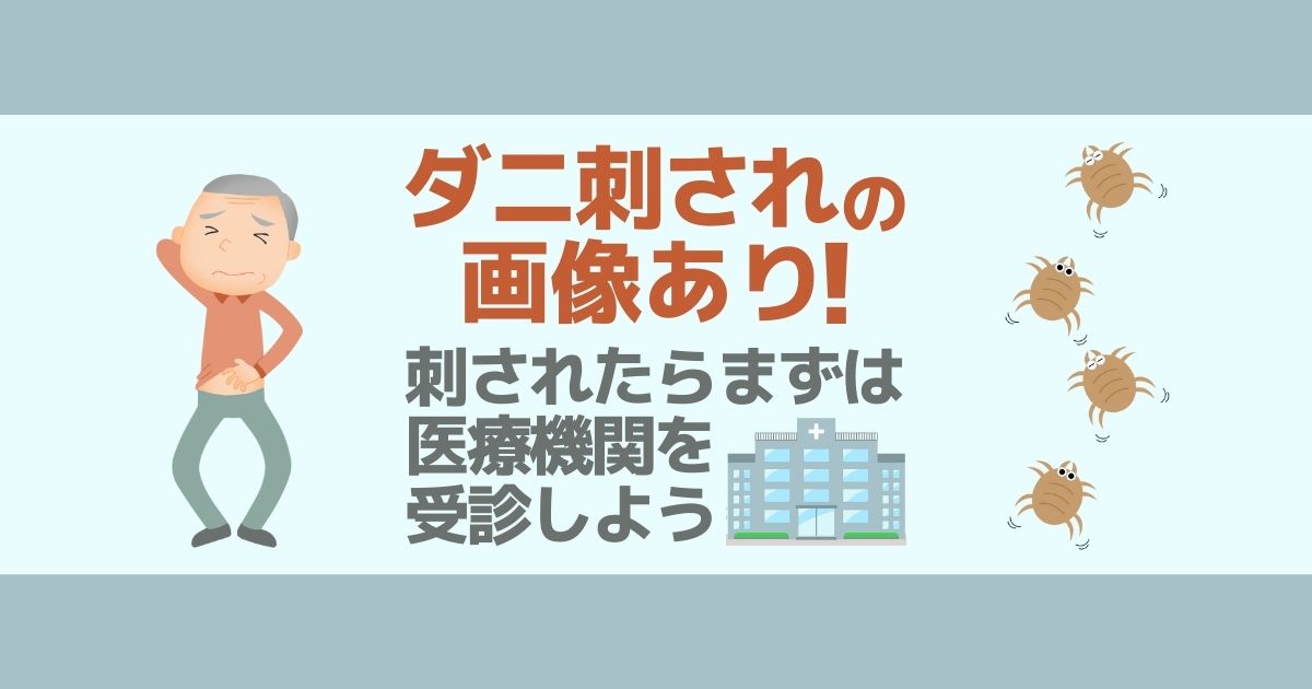 画像あり ダニに刺された跡の特徴 症状 対策もご紹介 害虫駆除110番